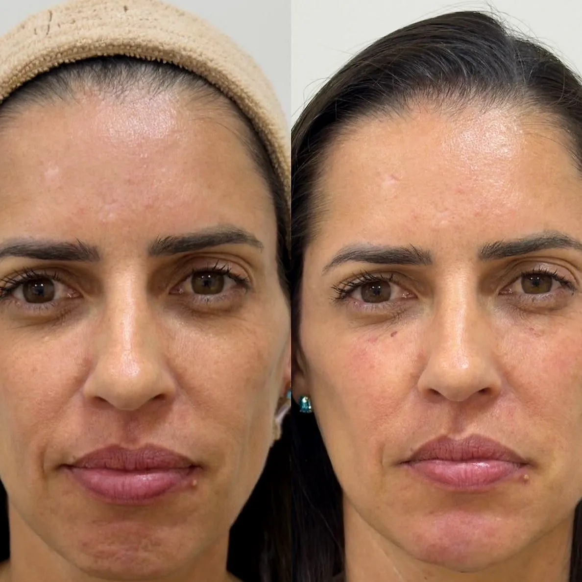 Olheiras profundas: antes e depois