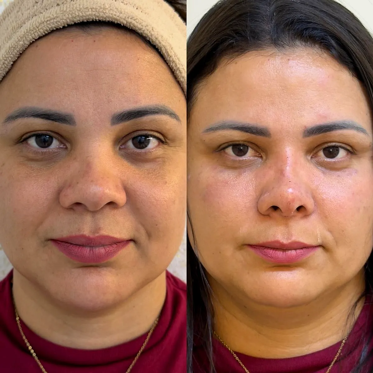 Olheiras e rinomodelação: antes e depois