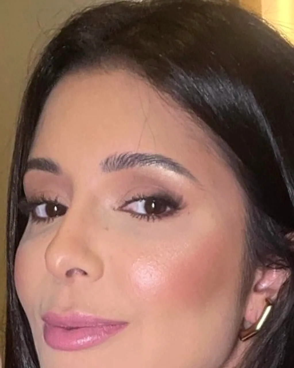 Dra. Stéphanny Neves depois da harmonização facial